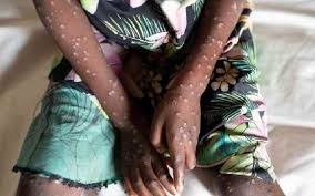 Kisa kingine cha ugonjwa wa M-Pox chapatikana huku maambukizi yakifikia watu 14